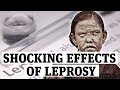 The shocking effects of leprosy