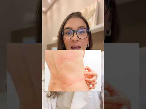 Urticária aguda é alergia? #alergista #alergia #urticaria