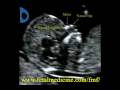 Fetal Medicine Foundation - Nasal bone