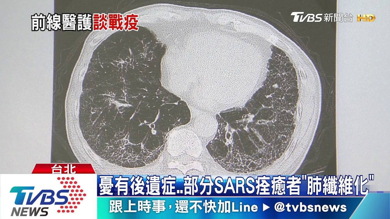 痊癒者憂肺纖維化　新冠肺炎治癒率最高國「是他」