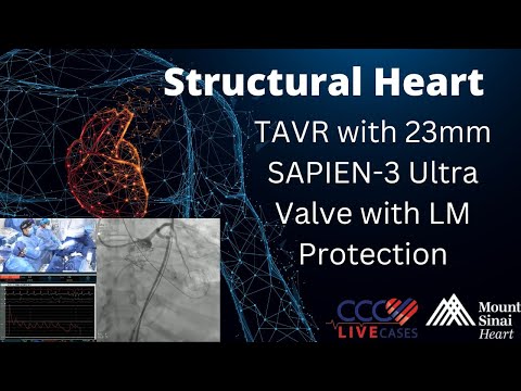 TAVR with 23mm SAPIEN-3 Ultra Valve with LM Protection