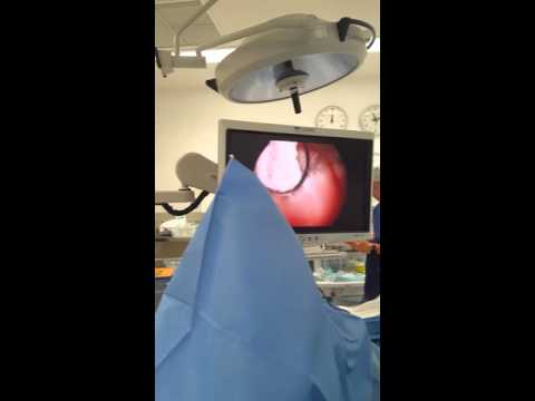 Podmore und Prostatitis Prostata-Selbstmassage