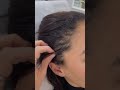 HAIR LOSS