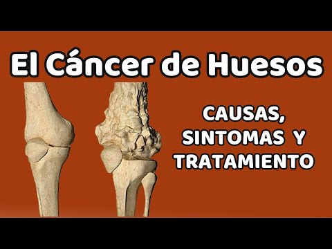 CÁNCER DE HUESOS, Causas, signos y síntomas, diagnóstico y tratamiento