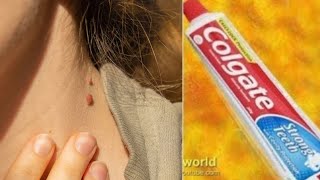 Remove Skin TAG Overnight With ToothPaste Remedy ( 100% WORKING) ll NGWorld