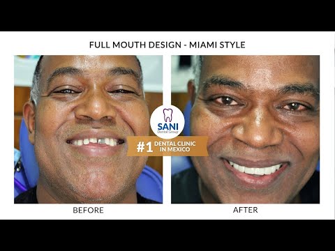 Amanuel Beyer's Full Mouth Restoration Journey with SANI Dental in Cancun, Mexico