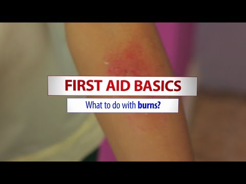 Basic first aid treatment for burns