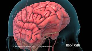 Ischemic Stroke Animation