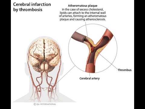Pathology of cerebral infarction or ischemic stroke; Pathophysiological Stages