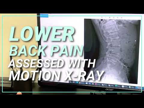 Lower Back in Motion X-Rays | Spine & Injury Medical Center | San Jose Chiropractor