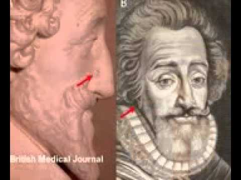 Forensics of King Henri IV's head