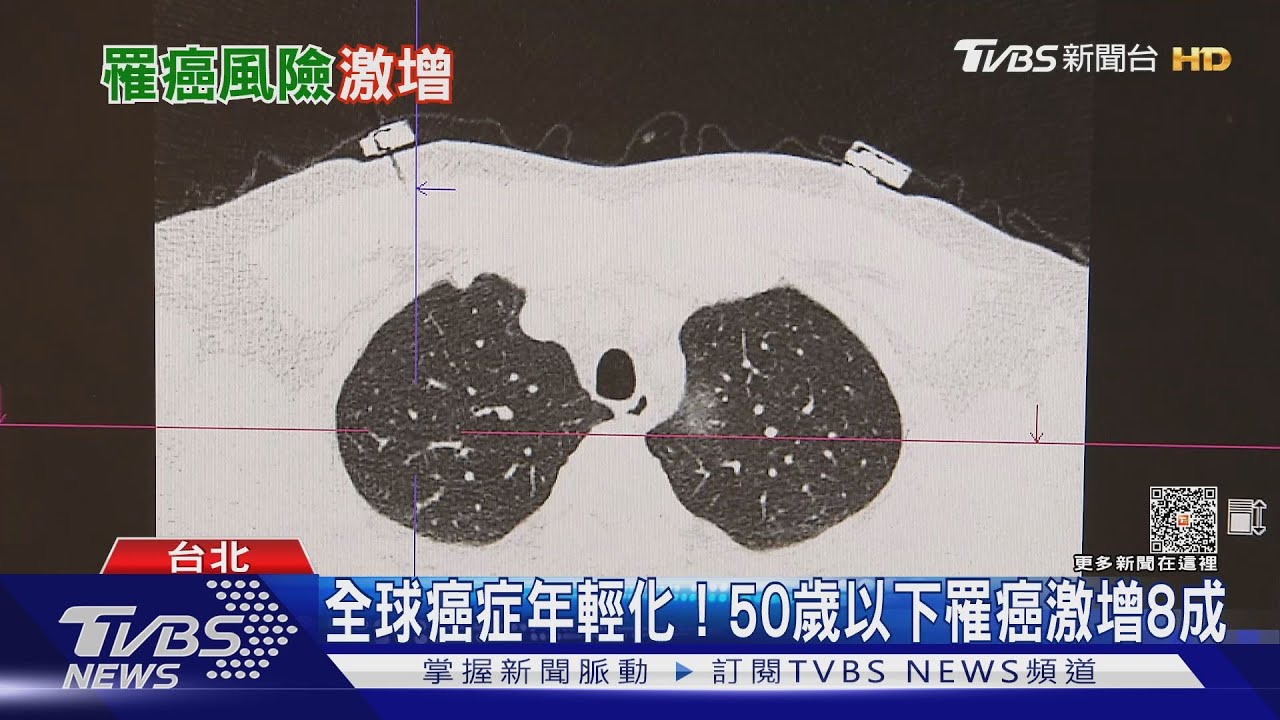 全球癌症年輕化！50歲以下罹癌人數成長近8成
