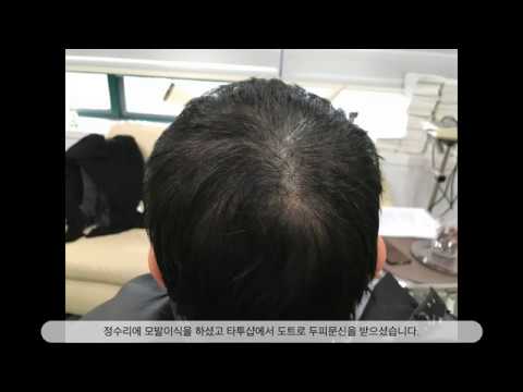 두피문신-모발이식을 해도 만족을 못한다면?