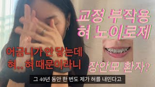 2. 저작 기능 상실. 내 인생을 망쳐버린 지옥같은 치아 교정... ’혀‘ 노이로제에 걸리다.