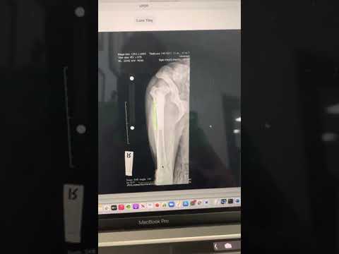 Some quick tips and tricks with pelvic radiographs and using calibration markers.