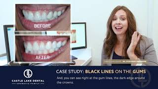 [Castle Lake Dental] Case Study: Black Lines on the Gums | Dentist in Lewisville TX 75056
