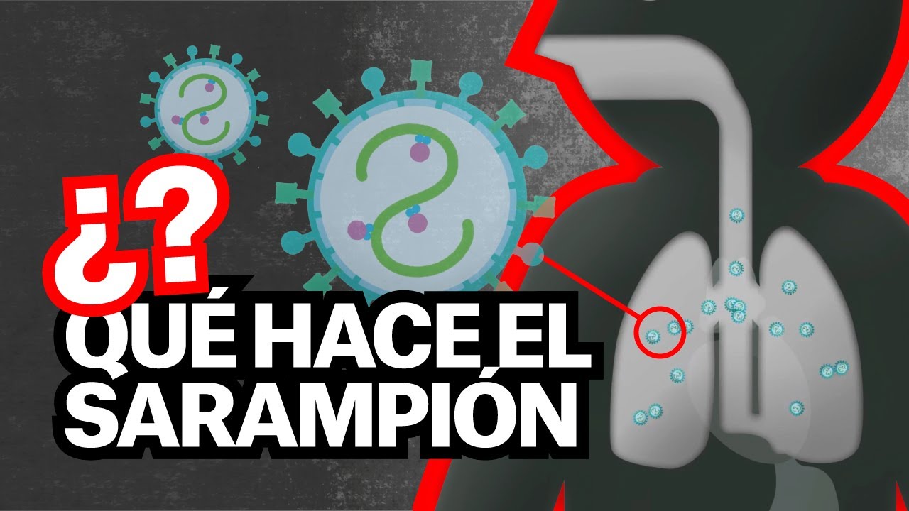 ¿Qué es el sarampión? ¿Cuáles son sus síntomas? ¿Cómo se contagia?