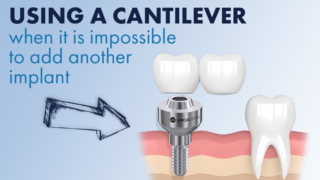 Using a cantilever when it is impossible to add another dental implant