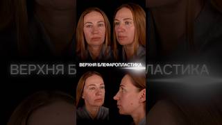 Пластика век (блефаропластика) 59