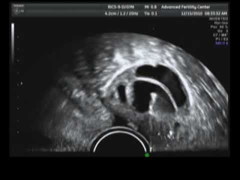 Egg Retrieval During IVF