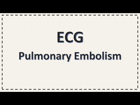 ECG in Pulmonary Embolism | S1Q3T3 | Simplified