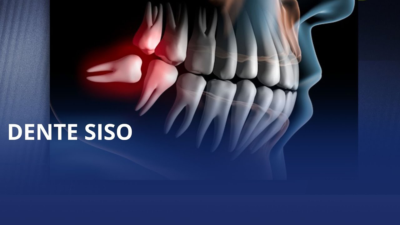 Dr. Rodrigo Gadottifala sobre mitos e verdades sobre o dente siso