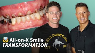 Discover the Life-Changing Power of All on 4 Dental Implants