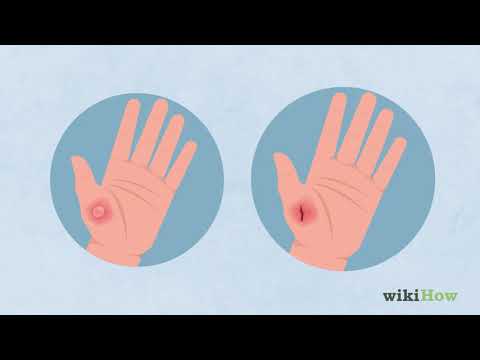 How to Treat an Ice Burn