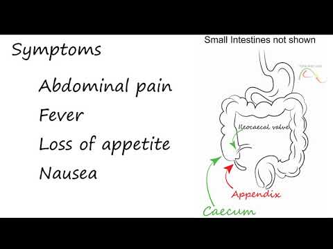 Acute Appendicitis - Acute Abdomen