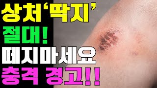 상처 딱지, 절대 떼지 마세요! 가려움증의 숨겨진 이유