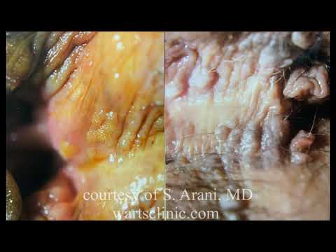 Confluent and reticulated papillomatosis vs tinea versicolor