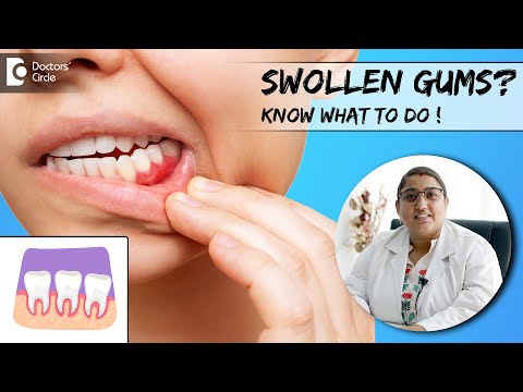 What Swollen Gums are telling you? Know its Home Remedies -Dr.Karthika Krishna Kumar|Doctors' Circle