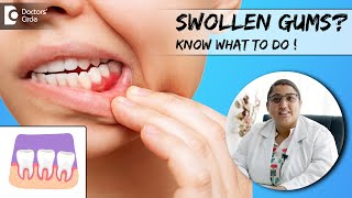 What Swollen Gums are telling you? Know its Home Remedies -Dr.Karthika Krishna Kumar|Doctors