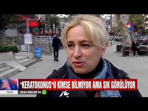 Op. Dr. Ertan Sunay – Star Tv Ana Haber – Keratokonus