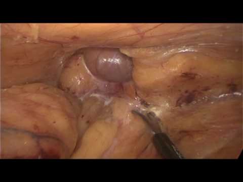 Scegliere un cuscino unernia ortopedica del rachide cervicale Mal di schiena aneddoto