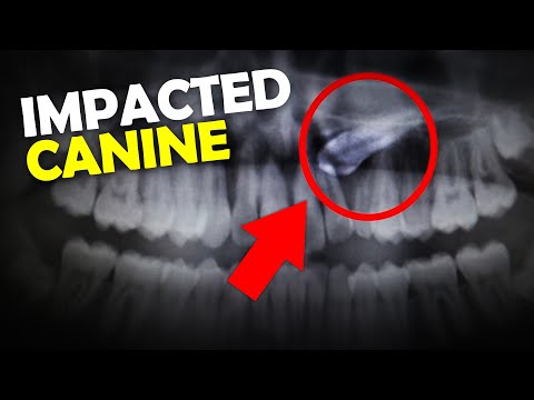 Impacted Canine Tooth: What are your options? [Ortho Explains]