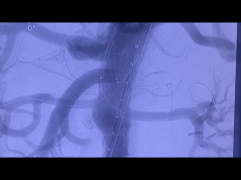 chEVAR || EVAR with Chimney Grafts To Both Renal Arteries || Dept Of Vascular Surgery || Max, Saket