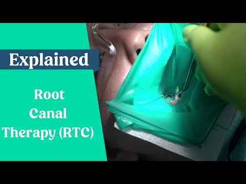 Root Canal Procedure (RCT) Explained