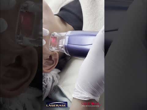 Watch on YouTube: thulium treatment jan 26