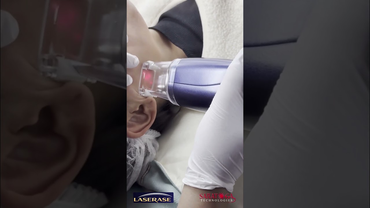 Watch LASERASE THULIUM Treatment Video