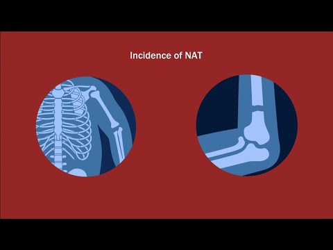 Transphyseal Distal Humeral Fractures