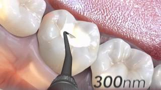 G-aenial Family & G-Premio BOND: A Winning Direct Restorative Combination for Esthetic Results