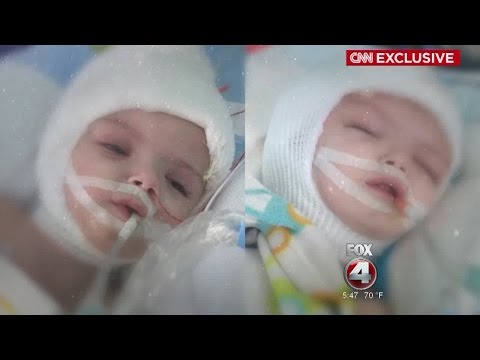Conjoined Twin Boys Recovering