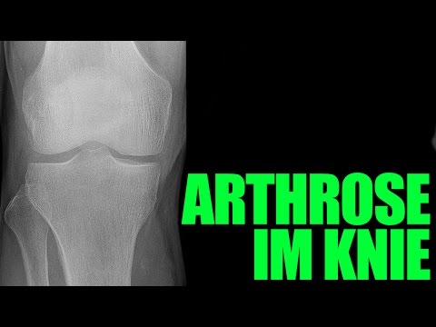 Lebensmittel in Osteochondrose der Halswirbelsäule Schmerzen im Nacken unter den Drüsen