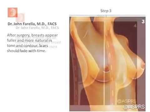Breast Implants | Dr. John F. Farella