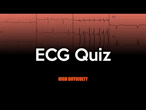 ECG Quiz: High Difficulty
