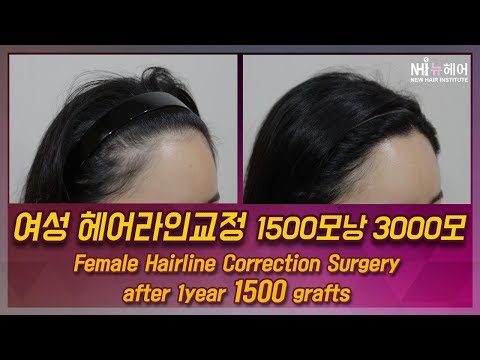 여성 헤어라인교정 1500모낭 3000모 Female Hairline Correction Surgery after 1year 1500 grafts(뉴헤어)