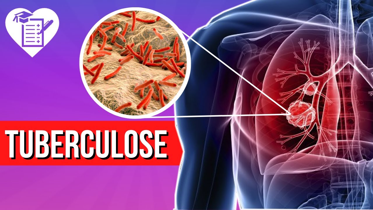 TUBERCULOSE: O que é, Sintomas e Tem Cura?