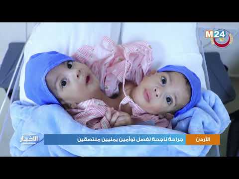 الأردن: جراحة ناجحة لفصل توأمين يمنيين ملتصقين