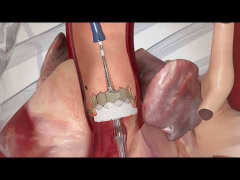 Valve SAPIEN 3 Ultra RESILIA